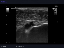 Ultrazvok rame - peritendinitis tetive m. biceps brachii prečno